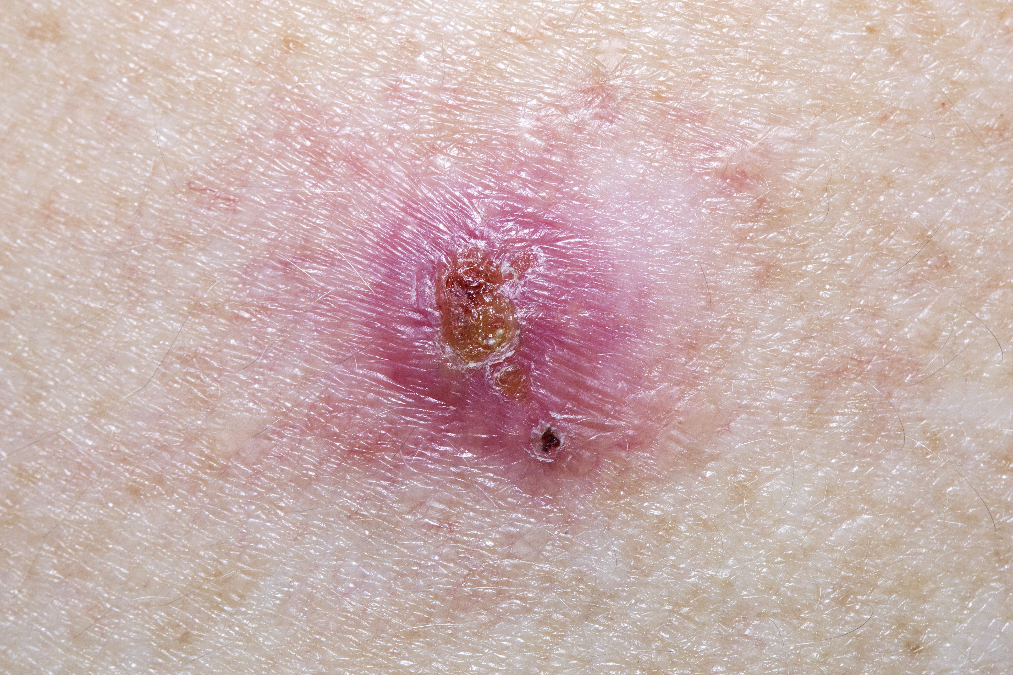 Basal cell carcinoma (BCC)