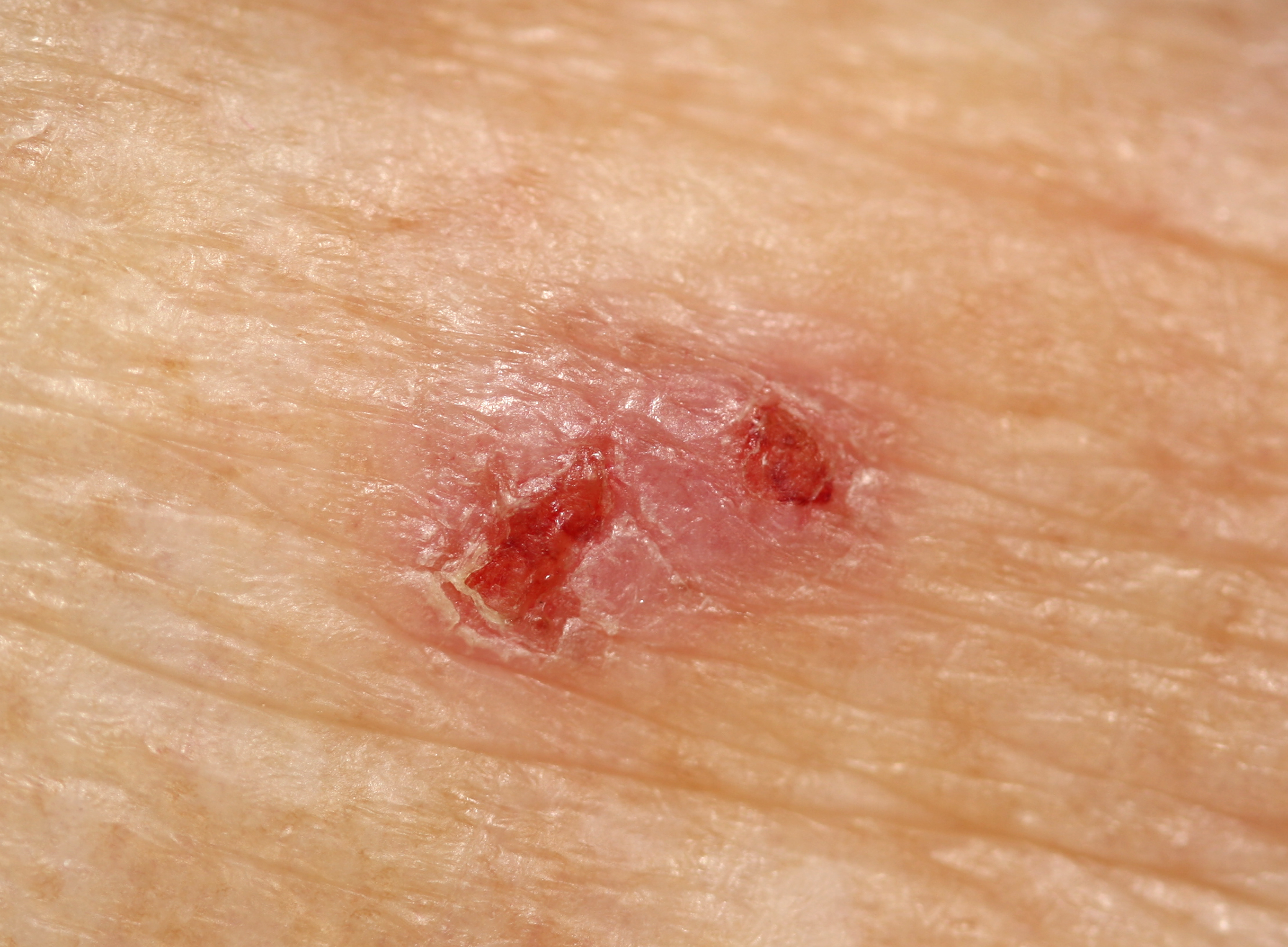 Bowen's disease
