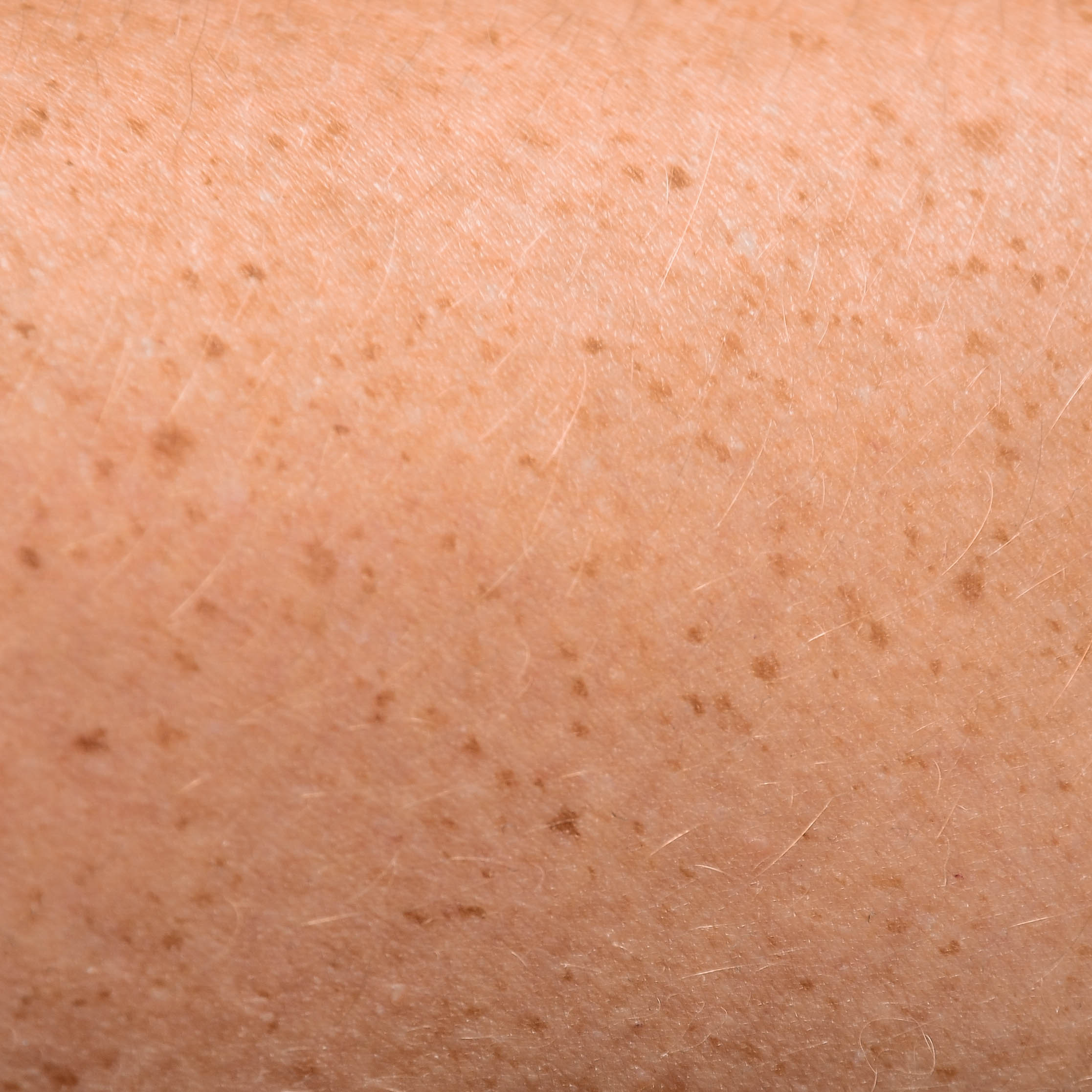 Freckles