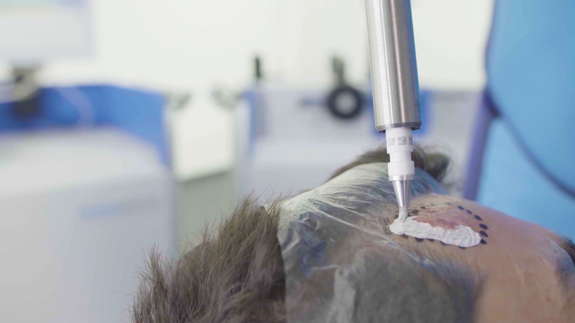 Rhenium-SCT Treatment