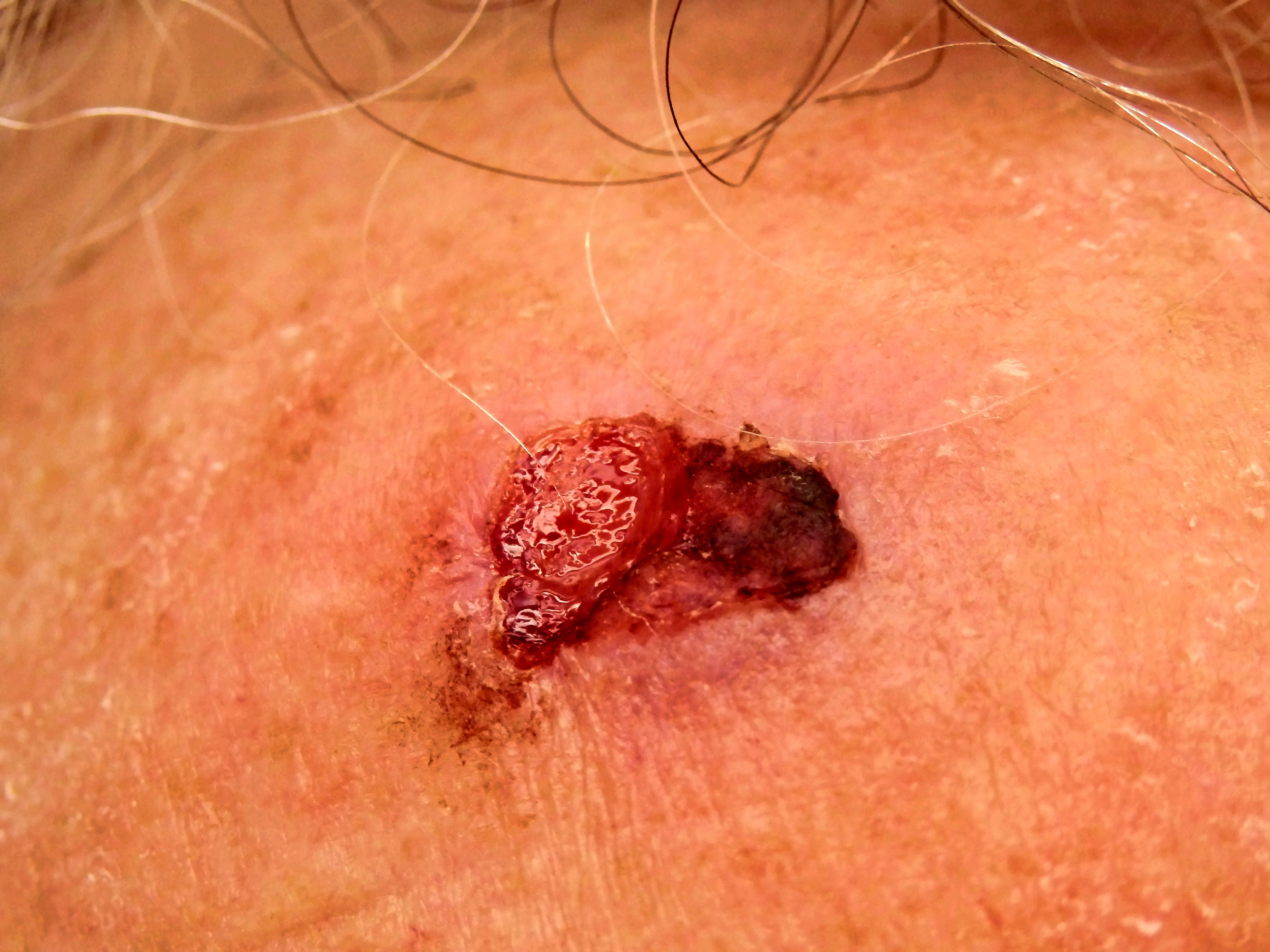 Squamous cell carcinoma (SCC)