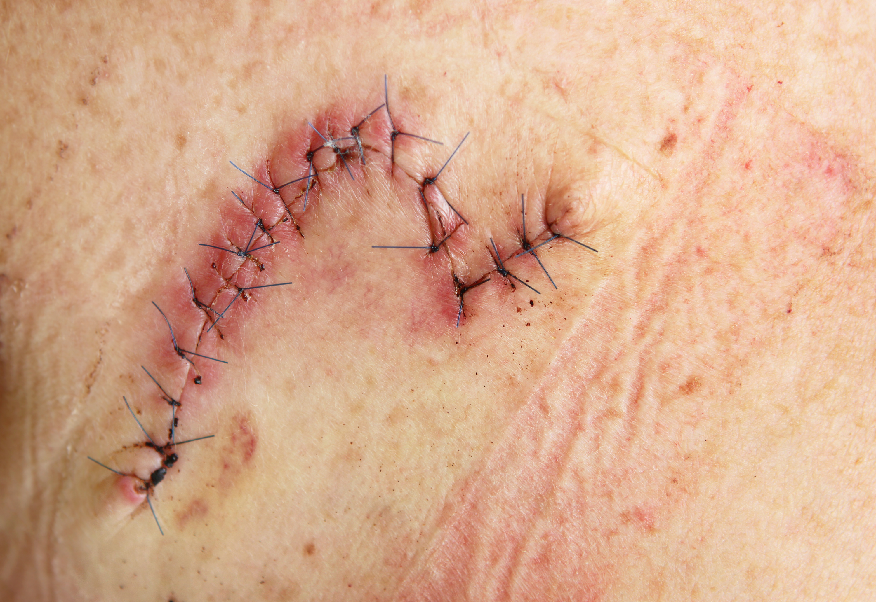 Surgical Treatment